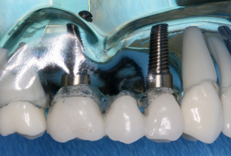 Die dentale Implantologie sowie der Kieferknochenaufbau ist seit langem ein fester Bestandteil unseres Leistungsspektrums.
